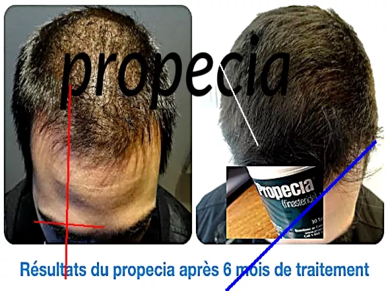 Finasteride propecia achat